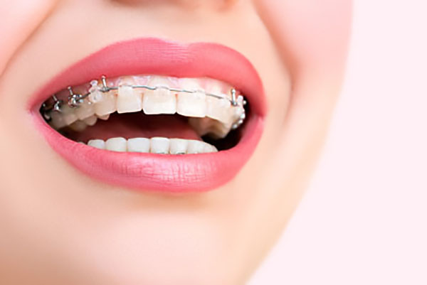 FAQs About Clear Braces