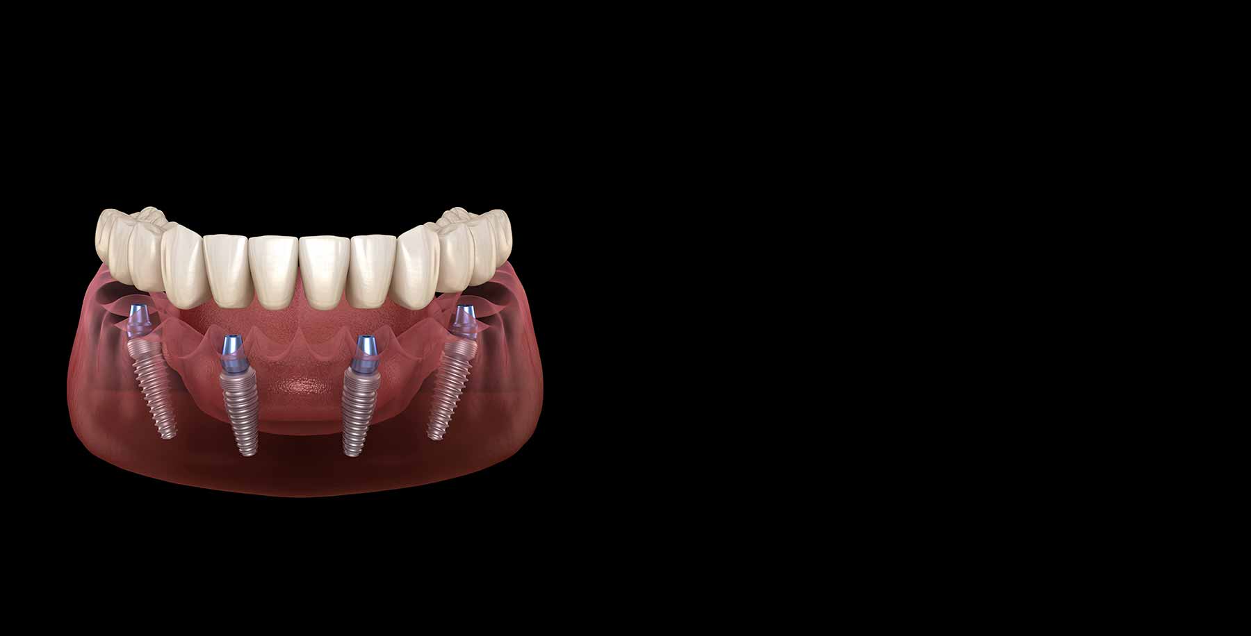 All-On-4® Implants