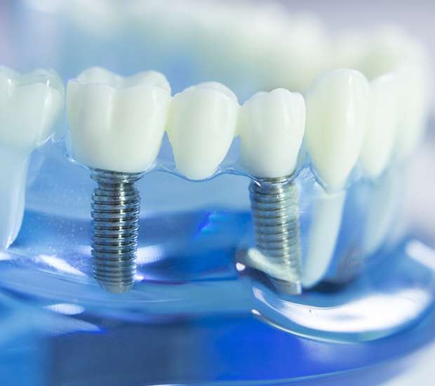 Atlantis Dental Implants